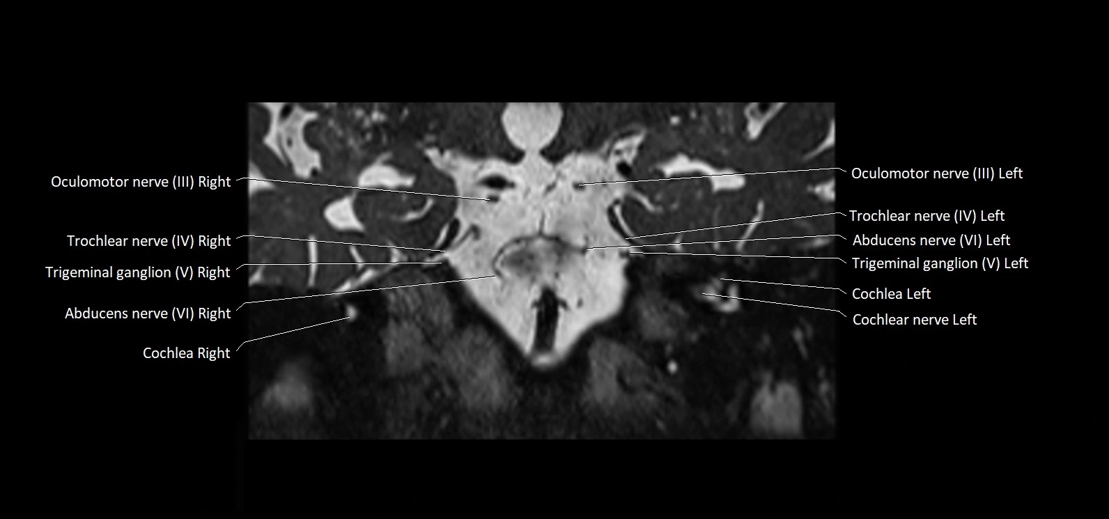 Cranial nerve cross sectional anatomy coronal 3T MRI image 37.webp